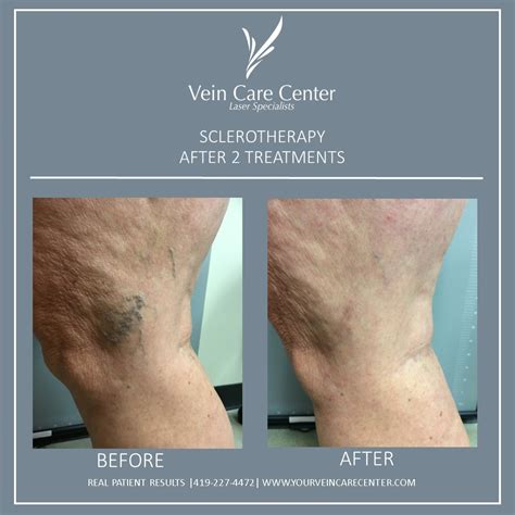 I use it on more than 5 patients a day and recommend a staged approach and to. Injection Sclerotherapy Lima, Ohio | Celina, OH | Bluffton ...