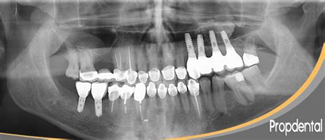 Ortopantomografía Para Implantes Dentales