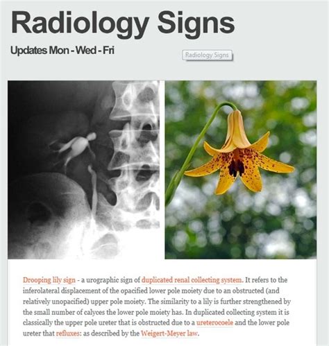 The Drooping Lily Sign Is A Urographic Sign In Some Patients With A