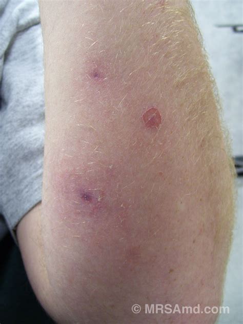 Early Stages Of Mrsa Symptoms