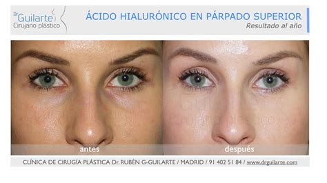 Acido Hialuronico Bolsas Ojos Antes Y Despues Consejos Ojos