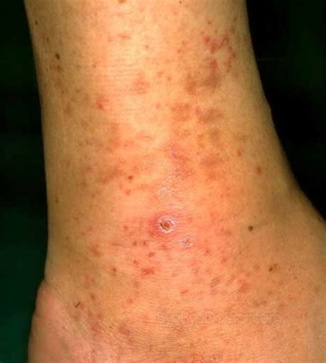 Red Itchy Bumps On Skin Causes Treatment Pictures Minhhai2d Help
