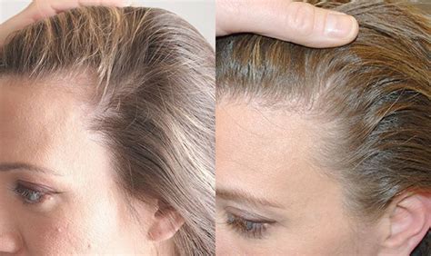 Female Hair Loss Northwest Hair Restoration