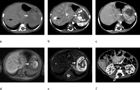 Axial Ct Scan Of The Abdomen In Unenhanced A Arterial B And