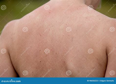 Skin Pigmentation Brown Spots Of Pigmentation On The Skin Of The Face