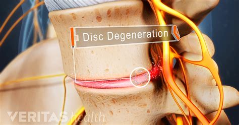 Lumbar Degenerative Disc Disease Overview Causes And Symptoms