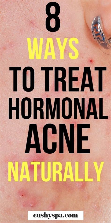 How To Treat Hormonal Acne Naturally Treatments Artofit