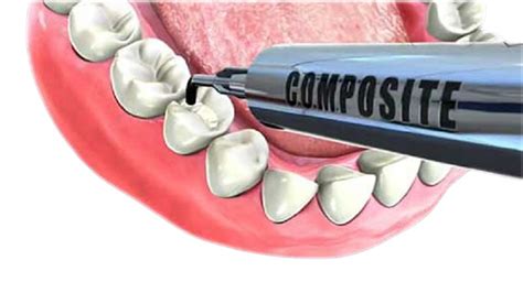 What Is Dental Composite And What Is It For Clinica Cardona