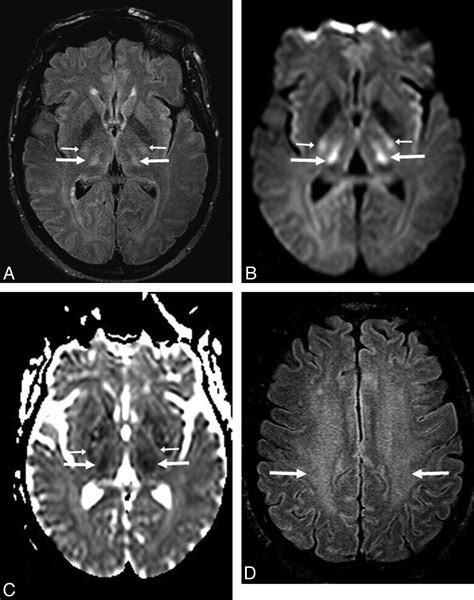 Acute Hepatic Encephalopathy Diffusion Weighted And Fluid Attenuated