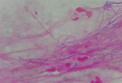 Figure A Presence Of Gram Positive Filamentous Bacteria Nocardia Spp