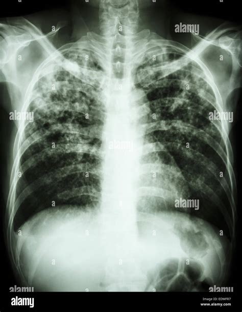Tuberculosis Rx Torax