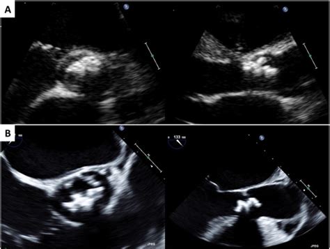 A Case Of Very Severe Aortic Stenosis Due To Unicuspid Aortic Valve