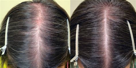 Topical Minoxidil Females Before And After Photos Hair Restoration Of
