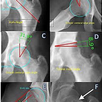 Pistol Grip Deformity As A Radiologic Sign Of Femoroacetabular