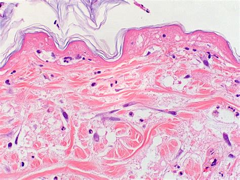 Effects Of Loxoscelism On Skin Extensive Coagulation Necrosis Of