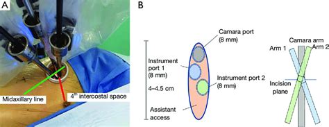 Layout Of Port In Uniportal Robotic Assisted Thoracoscopic Surgery