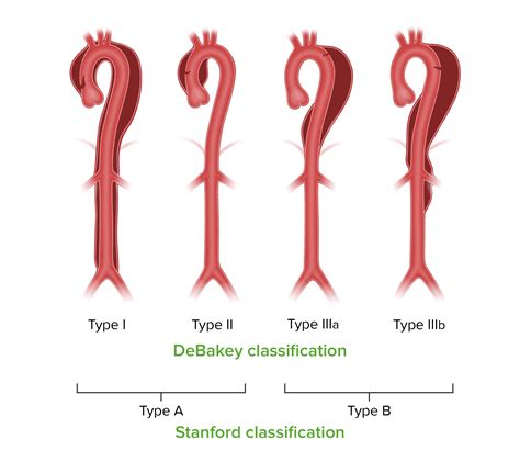 Aortic Dissection Symptoms Classification Treatment