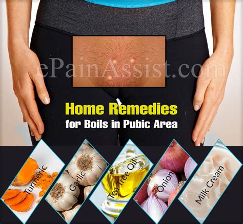 Treatment And Home Remedies For Boils In Pubic Area