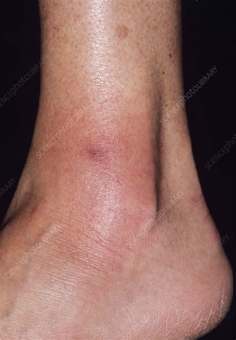 Cellulitis Stock Image M1300732 Science Photo Library