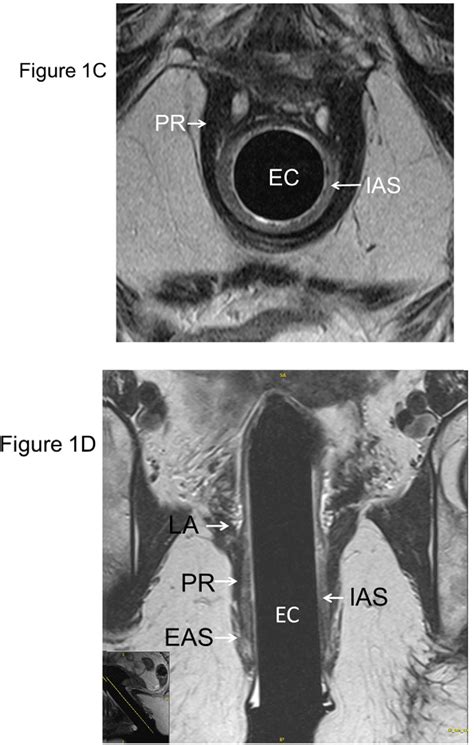 Figure From Relationship Among Anal Sphincter Injury Patulous Anal Canal And Anal Pressures