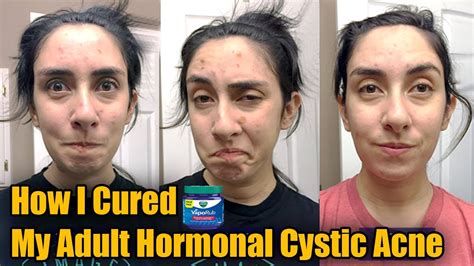 How I Cured My Adult Hormonal Cystic Acne Naturally No Accutane Acne
