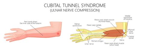 Cubital Tunnel Syndrome Nonsurgical Options Orlando Hand Surgery