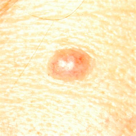 Skin Cancer Images Types Of Skin Cancer