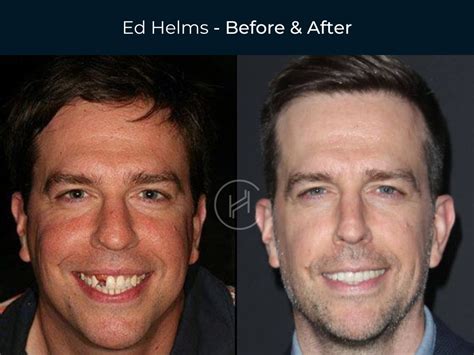 Celebrity Dental Implants And Veneers Before And After Photos