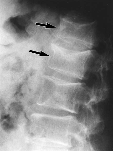 Underreporting Of Vertebral Fractures On Routine Chest Radiography Ajr
