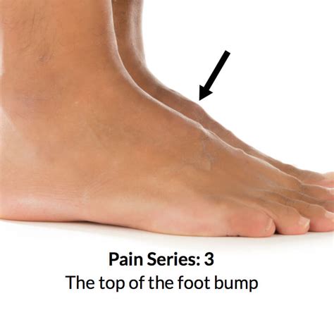 Foot Bump On Top Of The Foot Consulting Footpain