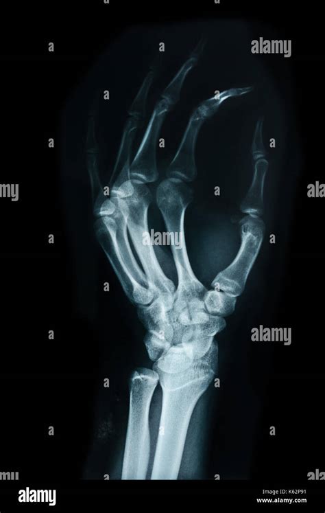 Carpal Bones Human X Ray On Black Stock Photo Alamy