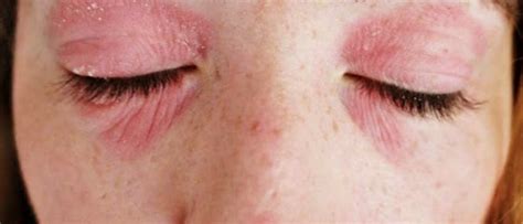Rash Around Eyes Causes Treatment And Pictures
