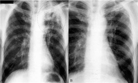 Tuberculosis Lungs