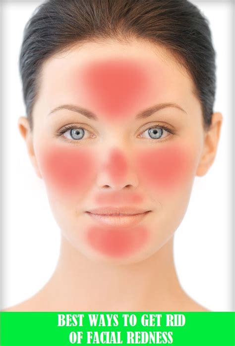 How To Get Rid Of Redness On Face 10 Best Home Remedies To Try