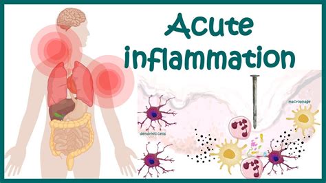 Acute Inflammation Symptoms Pathogenesis Cause Of Inflammation
