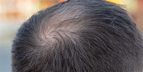 How To Handle A Bald Spot Miami Hair Institute