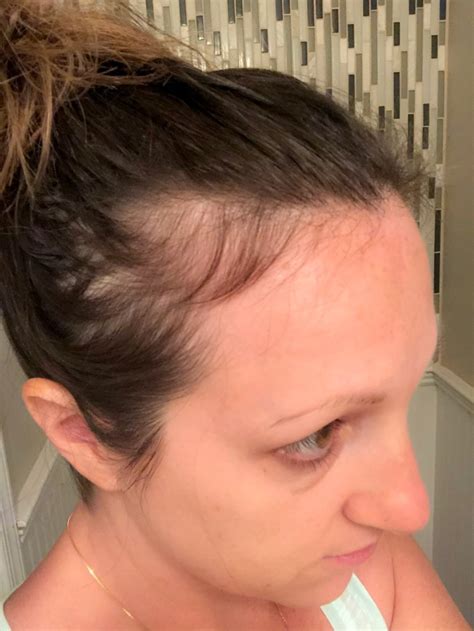 How To Quickly Cover Bald Spots During Postpartum Hair Loss Just
