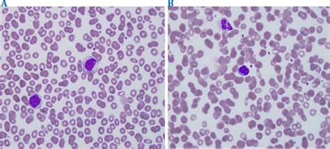 Blood Smear Comparing Normal Mononuclear Lymphocytes A And