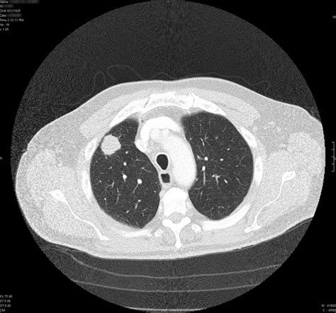 Low Dose Ct Scans Show Promise In Detecting Early Stage Lung Cancer