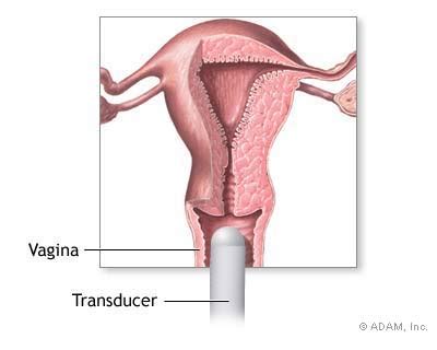 The New York Times Health Image Transvaginal Ultrasound