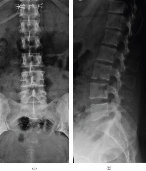 Partial flexion of knees as shown straighten the spine, which help to open intervertebral disk spaces. Thoracic and Lumbar Spine | Radiology Key