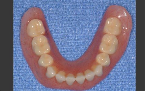 Complete Dentures Without Implants Female