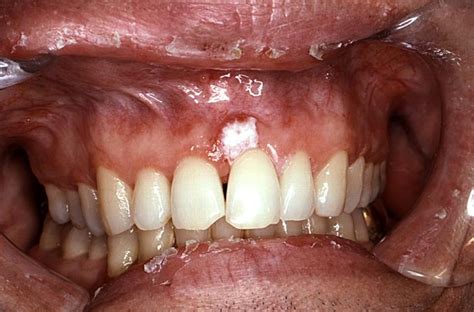 Gum Cancer Causes Symptoms Treatment Pictures Signs Healthmd