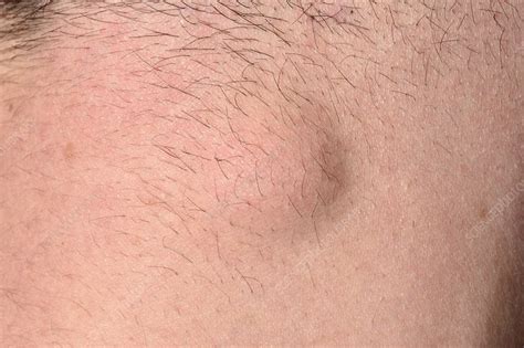 Sebaceous Cyst On Back Of Neck Stock Image C0426362 Science
