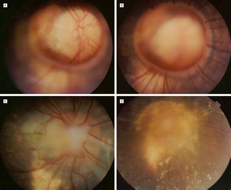 Peripapillary Staphyloma Cataract And Other Lens Disorders Jama