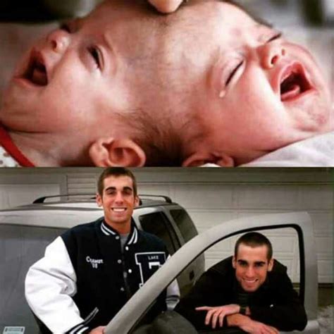 The Conjoined Twins Drbe Carson Separated See What They Look Like Now