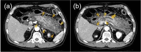 A Abdominal Contrast Ct On Admission Demonstrated A Swollen Pancreas