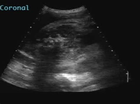 Horseshoe Kidney Ultrasoundpaedia