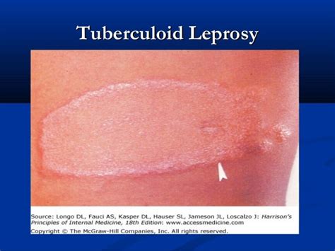 Borderline Tuberculoid Leprosy Leprosy Consists Of Macrophages With