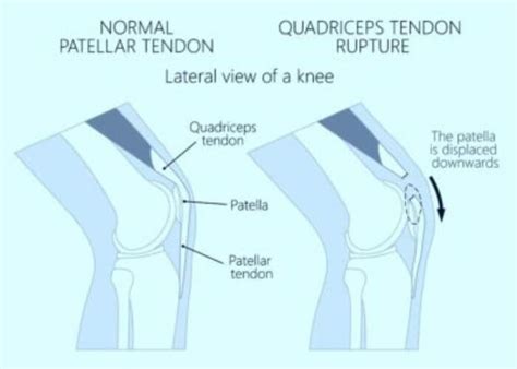 Quadriceps Tendon Rupture Repair Surgery Orthopedic Knee Surgeon Manhattan New York City Ny